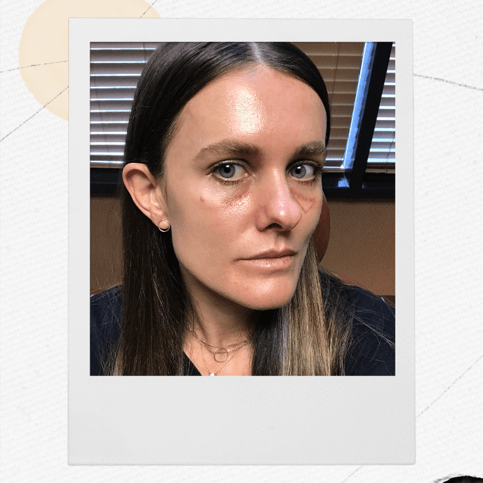 眼睛fillers-Sacha Strebe